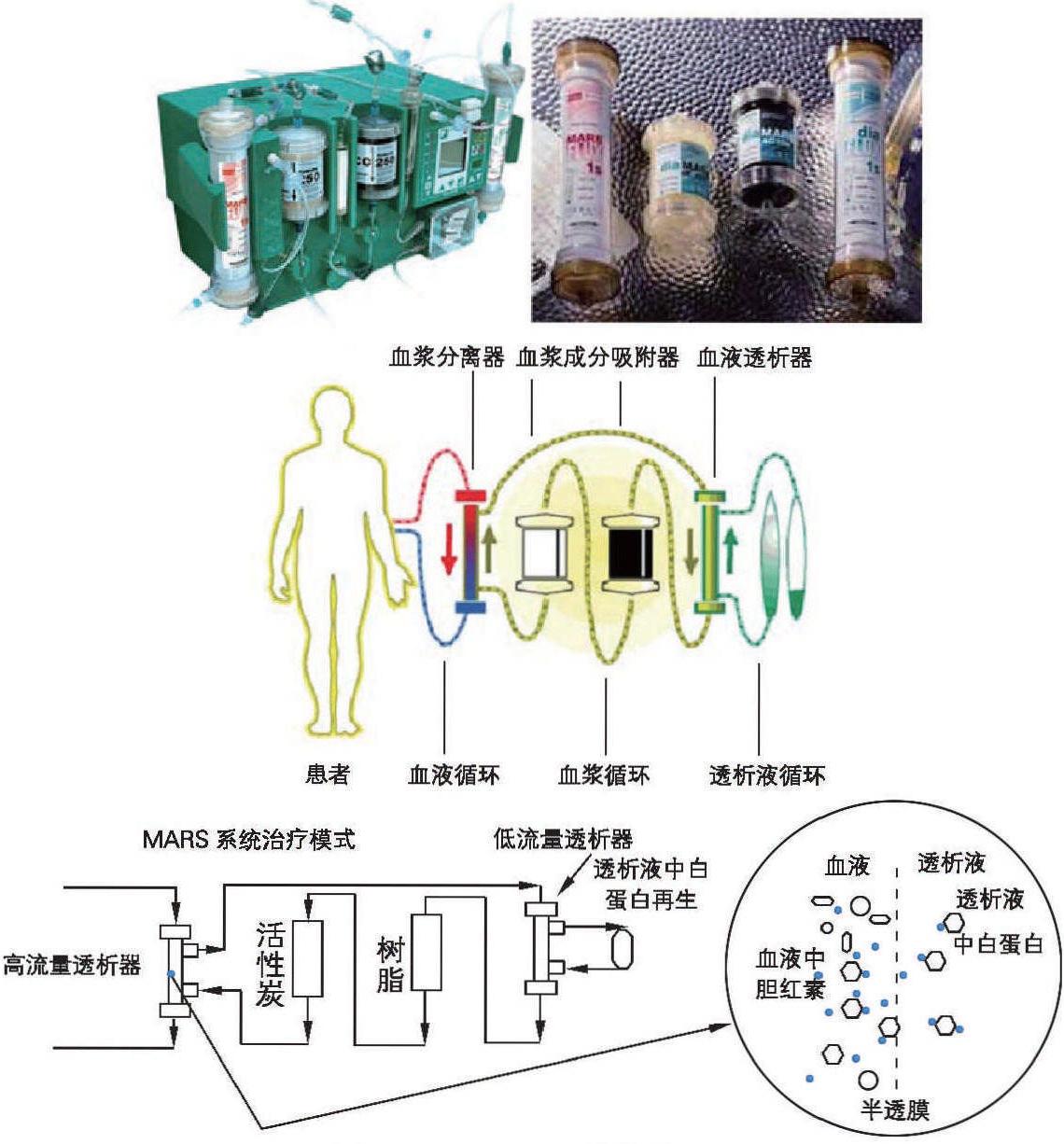 第5節(jié) 肝功能衰竭的血液凈化治療